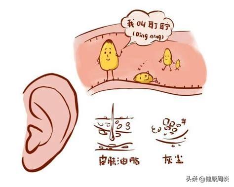 耳屎是怎么形成的