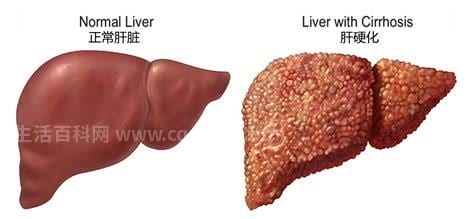 肝硬化有什么征兆