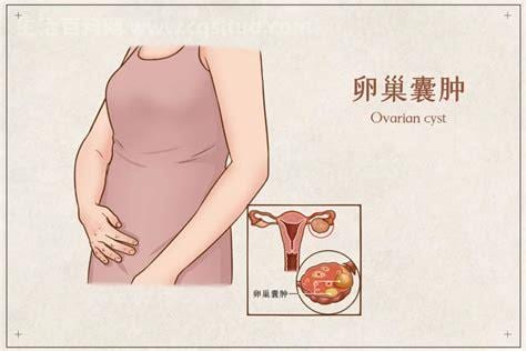 初期卵巢囊肿什么症状