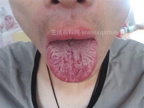 口腔溃疡舌头也烂怎么回事