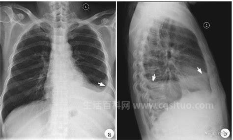 结核性胸膜炎的症状及治疗