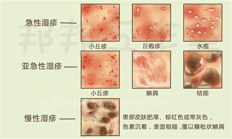 湿疹是因为湿气太重吗