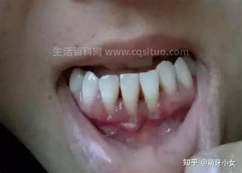 牙龈萎缩能自身修复吗