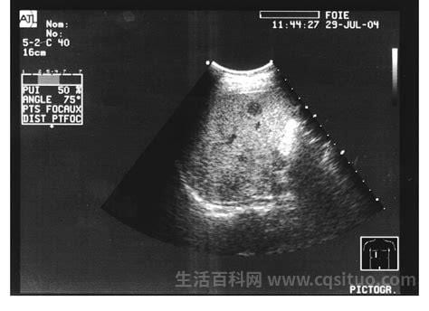 肝内血管瘤是怎么引起的