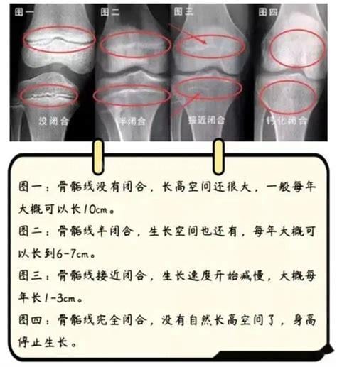 骨骺线闭合的表现