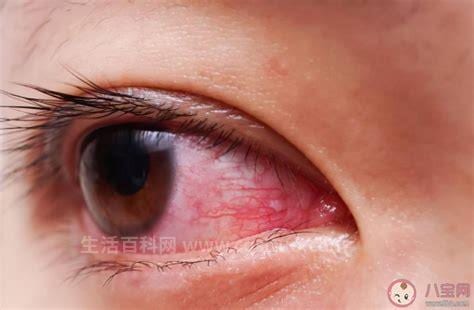 眼睛白眼球上有红血丝是什么原因