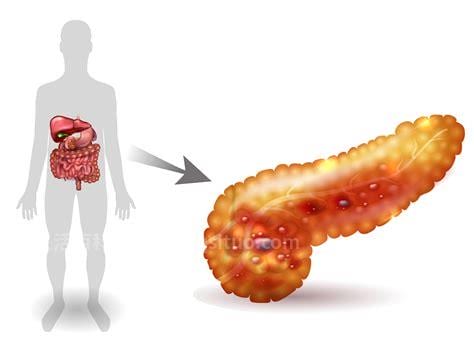 胰腺炎和胃炎症状的区别