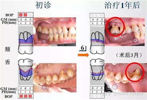 牙周病的治疗方法