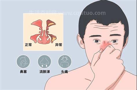 长期鼻窦炎会不会癌变