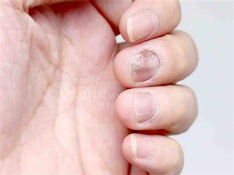 灰指甲的治疗方法是什么