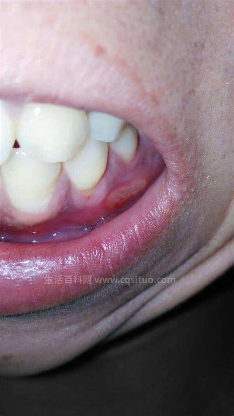 牙龈增生的症状