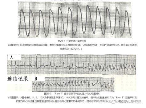 心室颤动是什么意思