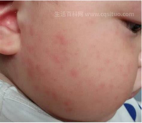 幼儿急疹的症状和治疗方法
