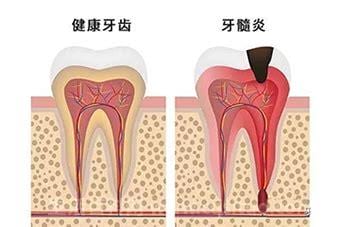 牙髓炎怎么快速止痛