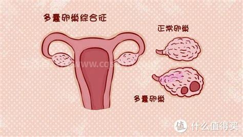 卵巢多囊样改变严重吗