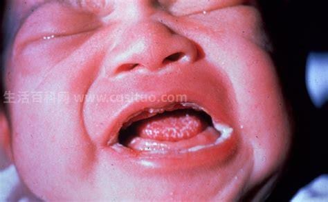 什么是口腔白色念珠菌病