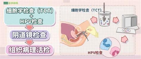 宫颈tct检查是什么意思