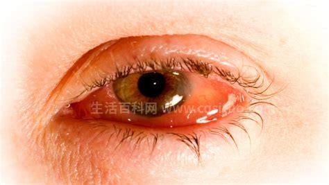 红眼病是怎么引发的