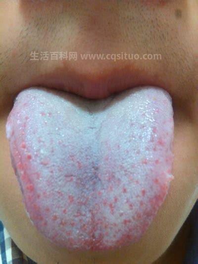 舌头上有白色苔藓是怎么回事