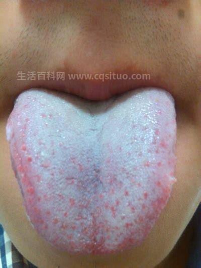 舌头白苔厚是什么原因引起的