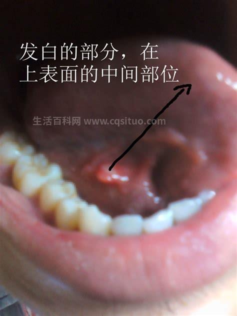 早期舌癌有什么症状
