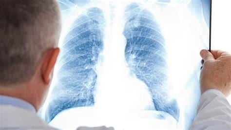 肺结核能活多久