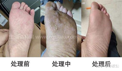 湿疹和脚气的区别