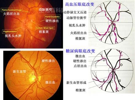 视网膜黄斑病变要怎么治疗