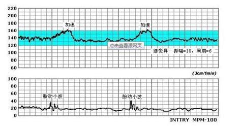 胎心监护图怎么看