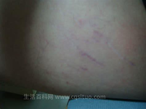 大腿两侧出现紫红色血丝状疤痕图片