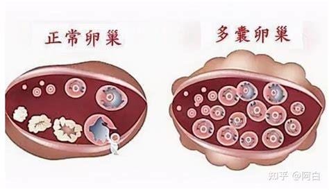 多囊性卵巢症候群是什么病