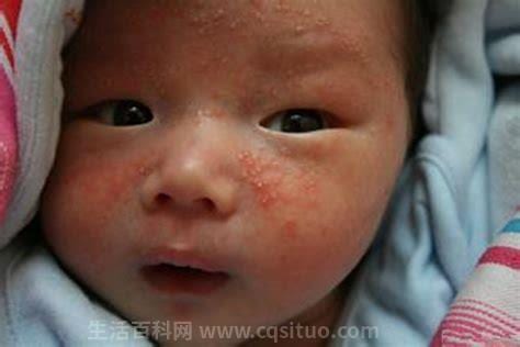 婴儿湿疹症状图片 婴儿湿疹的症状