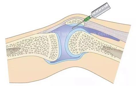 玻璃酸钠治疗膝关节炎注射方法