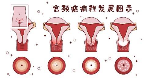 hpv16阳性几年得癌症