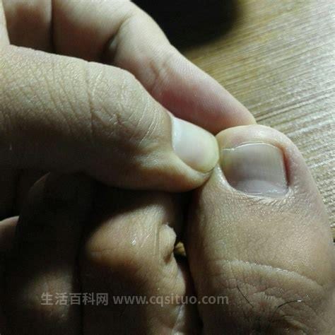 指甲缝里长一层透明肉是什么原因引起