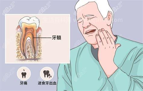 牙髓炎不治疗能疼几天