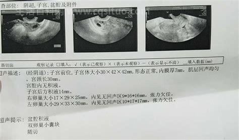 卵巢囊肿影响来月经吗