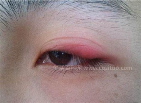 眼睑缘炎症状是什么