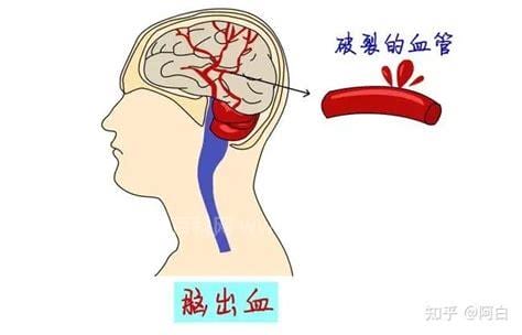 突发脑溢血怎么急救