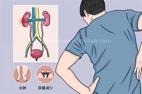 肾病综合征的临床表现有哪些