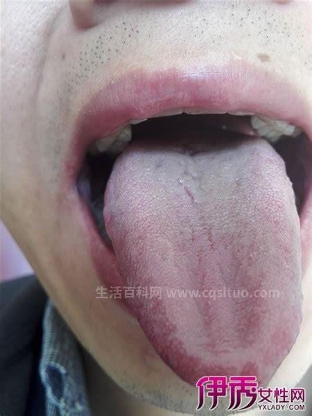 舌根部淋巴滤泡增生是怎么回事