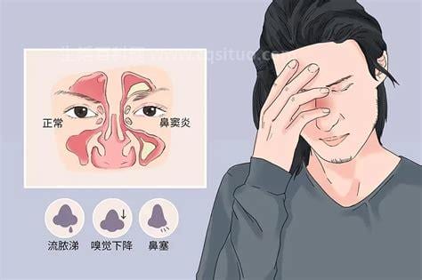 鼻窦炎有哪些症状怎么治疗