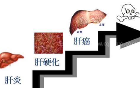 肝癌死前1个月的症状