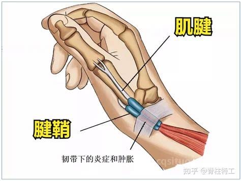 脚面腱鞘炎症状