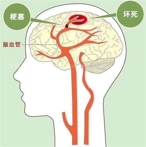 脑腔梗的治疗方法