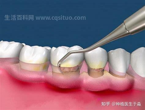 38岁牙龈萎缩可以恢复吗