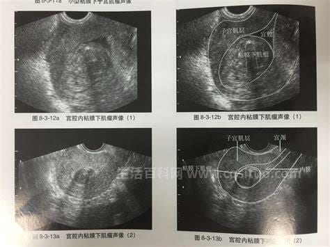 子宫肉瘤有哪几种类型