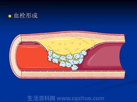 血栓症状是什么