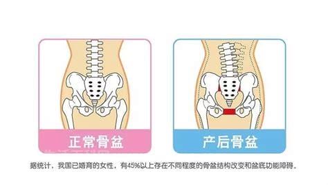 产后骨盆修复有必要吗