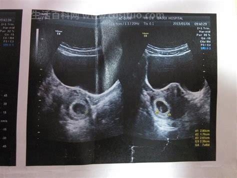 怀孕多少天b超可以看到孕囊